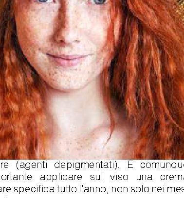 Perché alcune persone hanno le lentiggini?